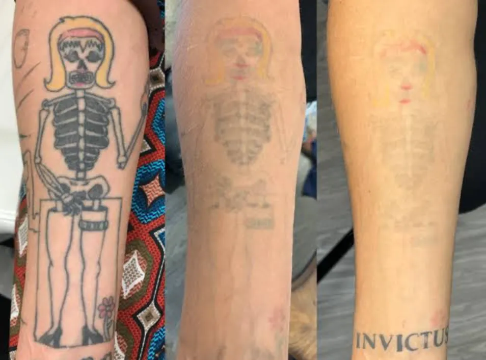 What to Expect After a Tattoo Removal Session